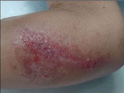 全身性濕疹的危害有哪些？