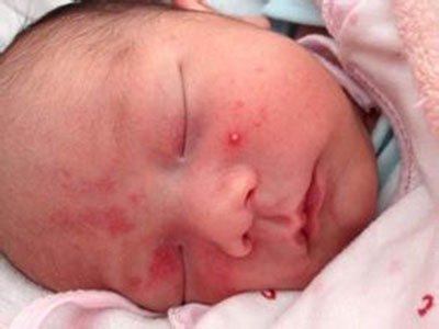 寶寶起濕疹的原因是什麼？藥物能治嗎