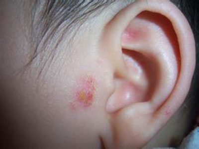 兒童臉部濕疹怎麼辦