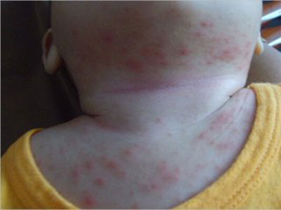 濕疹的原因是什麼 有哪些症狀