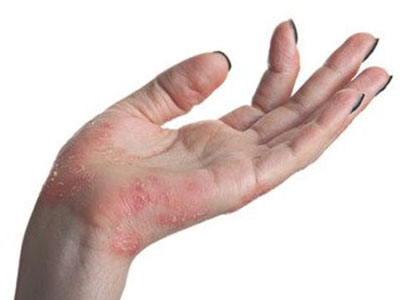 疥瘡會引起濕疹嗎 濕疹病因有什麼呢