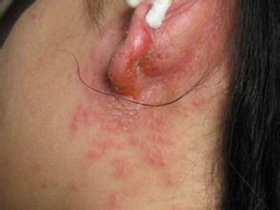 外陰長濕疹是怎麼原因 怎麼治療外陰濕疹