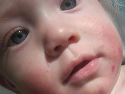 濕疹過敏是奶粉引起的嗎 什麼原因會引起嬰兒濕疹