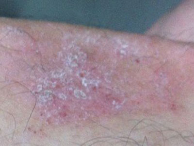濕疹有哪些表現及如何診斷？