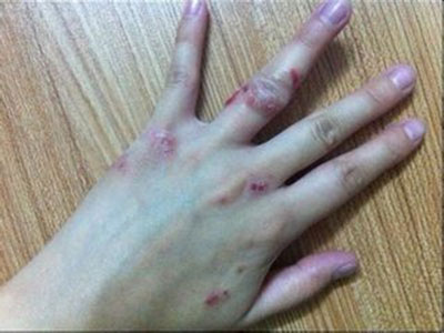 皮膚上長濕疹有什麼症狀