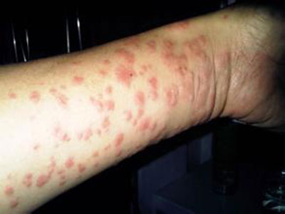 四肢濕疹的臨床表現是什麼