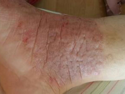 腳上出現濕疹的原因是什麼
