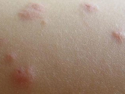 全身濕疹應該怎麼進行治療？