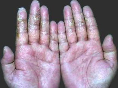 手指濕疹的治療方法？