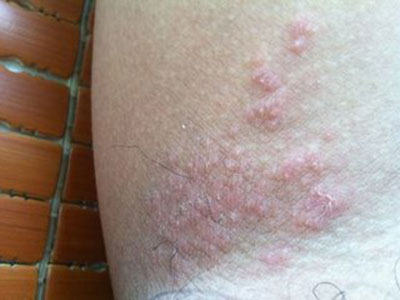 增生是濕疹的症狀嗎