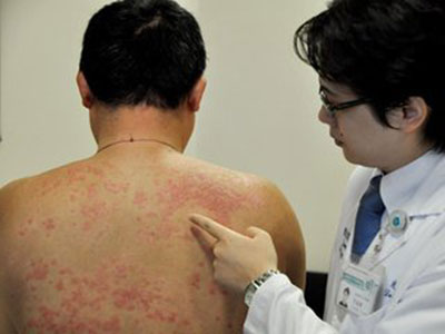 介紹下濕疹的保健常識