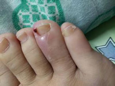 腳指甲生長慢的原因那些？