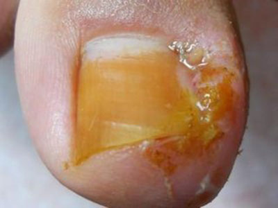 灰指甲如何預防復發？