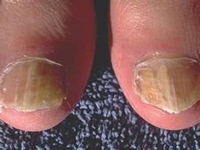 腳趾甲溝炎怎麼治 有什麼注意事項呢