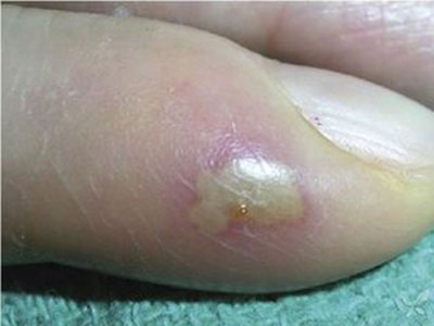 甲溝炎患者該怎樣用指甲刀拔甲呢 又該怎麼護理