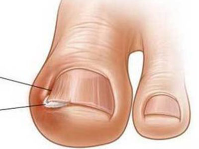 指甲刀使用不正確會導致甲溝炎嗎 要怎麼護理
