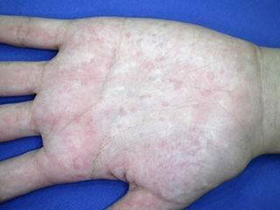 扁平疣的皮疹如何診斷？