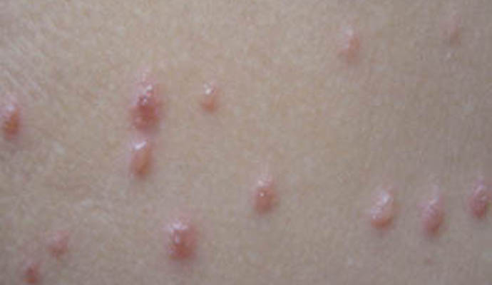 媽媽們要知道！“水痘”容易引發並發症！要如何護理？