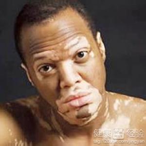 白癜風的常見原因分析