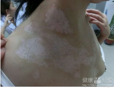 女性患上白癜風要注意