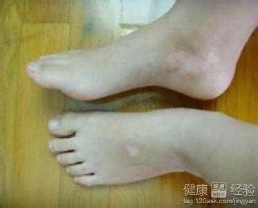 口腔白癜風怎麼治療