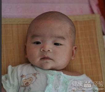嬰幼兒白癜風早期症狀