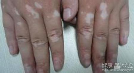 患上了白癜風這種皮膚病要怎麼治療？