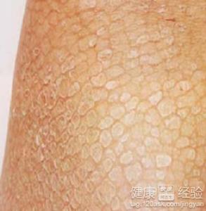 輕微魚鱗病怎麼保養皮膚保濕護理最為重要