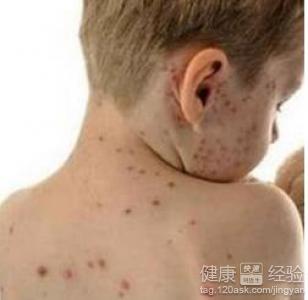 荨麻疹在發病期間要注意什麼問題?