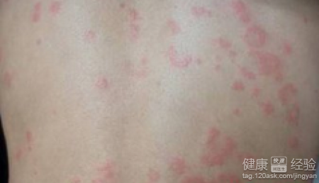 寒性荨麻疹的症狀有哪些