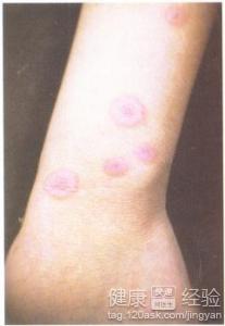 丘疹性荨麻疹是怎麼引起的