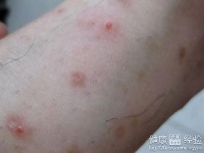 丘疹性荨麻疹是什麼原因引起