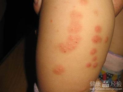 丘疹性荨麻疹的鑒別診斷