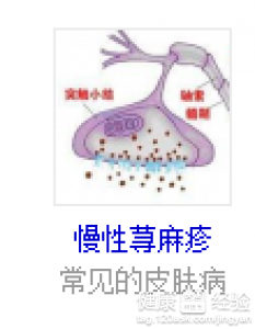 荨麻疹不可以喝什麼類型的湯水