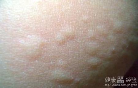 皮膚過敏每到深夜全身皮膚奇癢並伴有大面積荨麻疹怎麼辦