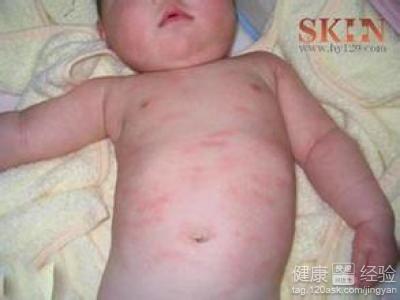 嬰兒得了荨麻疹怎麼辦