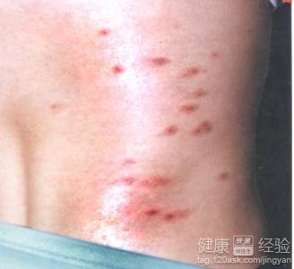 荨麻疹的預防工作如何做