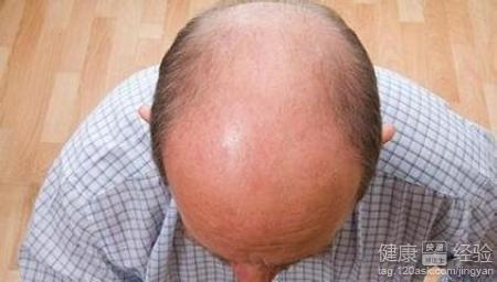 男性出現禿頂的原因有哪些？