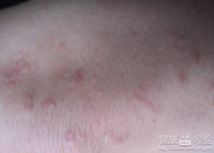 日常生活如何預防魚鱗病