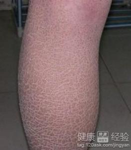 魚鱗病現在是否有什麼好藥可以治療