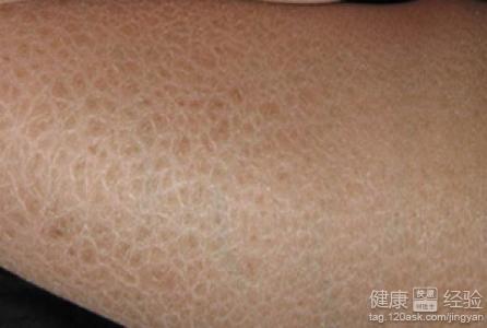 皮膚有魚鱗病怎麼預防