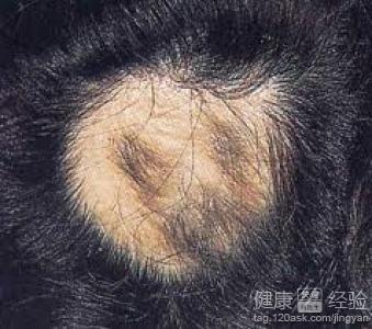 斑禿恢復期的症狀