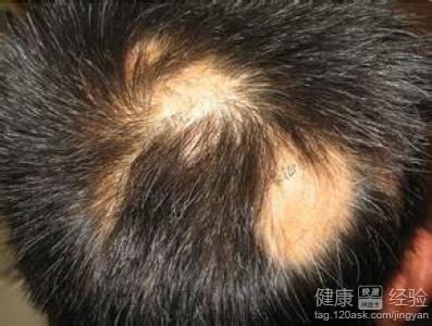 斑禿吃什麼補品