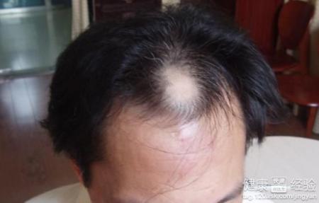 斑禿跟頭皮受刺激有關系嗎