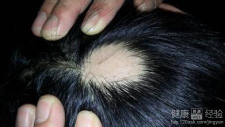 斑禿用冷凍治療需要多久才可以長出頭發