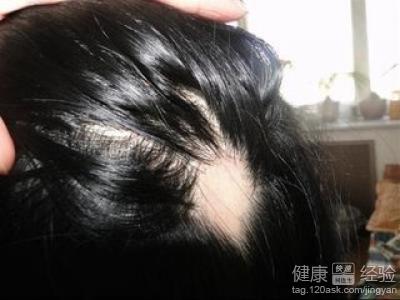 3歲兒童脫發斑禿能治好嗎