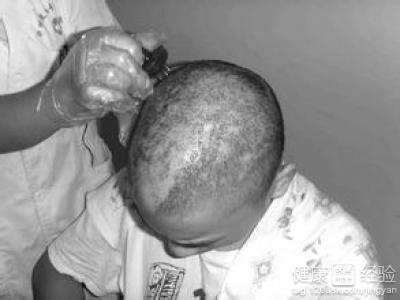治療復發性的斑禿的有效辦法