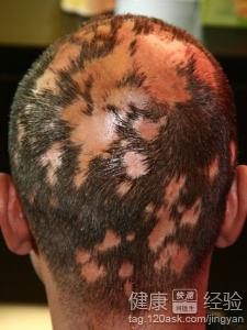 頭癬引起很多小斑禿要怎麼治