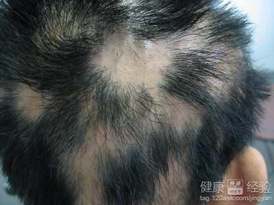 頭發稀疏易掉還出現斑禿是什麼原因