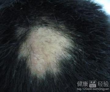 生姜治療斑禿有副作用嗎